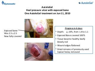 AutoloGel
                     Heel pressure ulcer with exposed bone
                    One AutoloGel treatment on Jun 11, 2010




                                                       Progress in 4 days
Exposed bone                                  • Depth: ↓ 23%, from 1.4 to 1.1
Was 2.5 x 2.5
Now fully covered                             • Exposed Bone covered 100%
                                              • Tissue became healthy beefy
                                                bloody red
                                              • Wound edges flattened
                                              • Dried remains of previously used
                                                topical honey removed
 