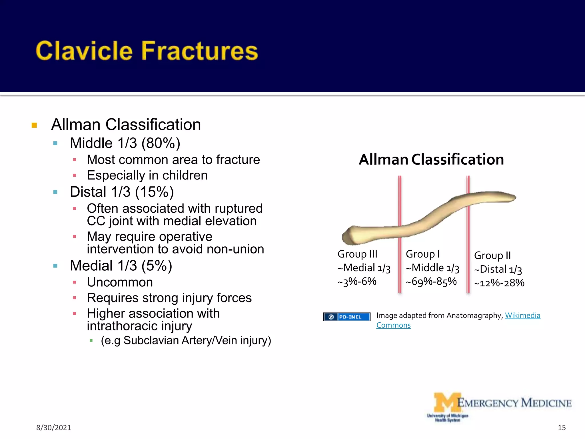  Allman Classification
 Middle 1/3 (80%)
▪ Most common area to fracture
▪ Especially in children
 Distal 1/3 (15%)
▪ Often associated with ruptured
CC joint with medial elevation
▪ May require operative
intervention to avoid non-union
 Medial 1/3 (5%)
▪ Uncommon
▪ Requires strong injury forces
▪ Higher association with
intrathoracic injury
▪ (e.g Subclavian Artery/Vein injury)
15
Image adapted from Anatomagraphy, Wikimedia
Commons
Group III
~Medial 1/3
~3%-6%
Group I
~Middle 1/3
~69%-85%
Group II
~Distal 1/3
~12%-28%
Allman Classification
8/30/2021
 