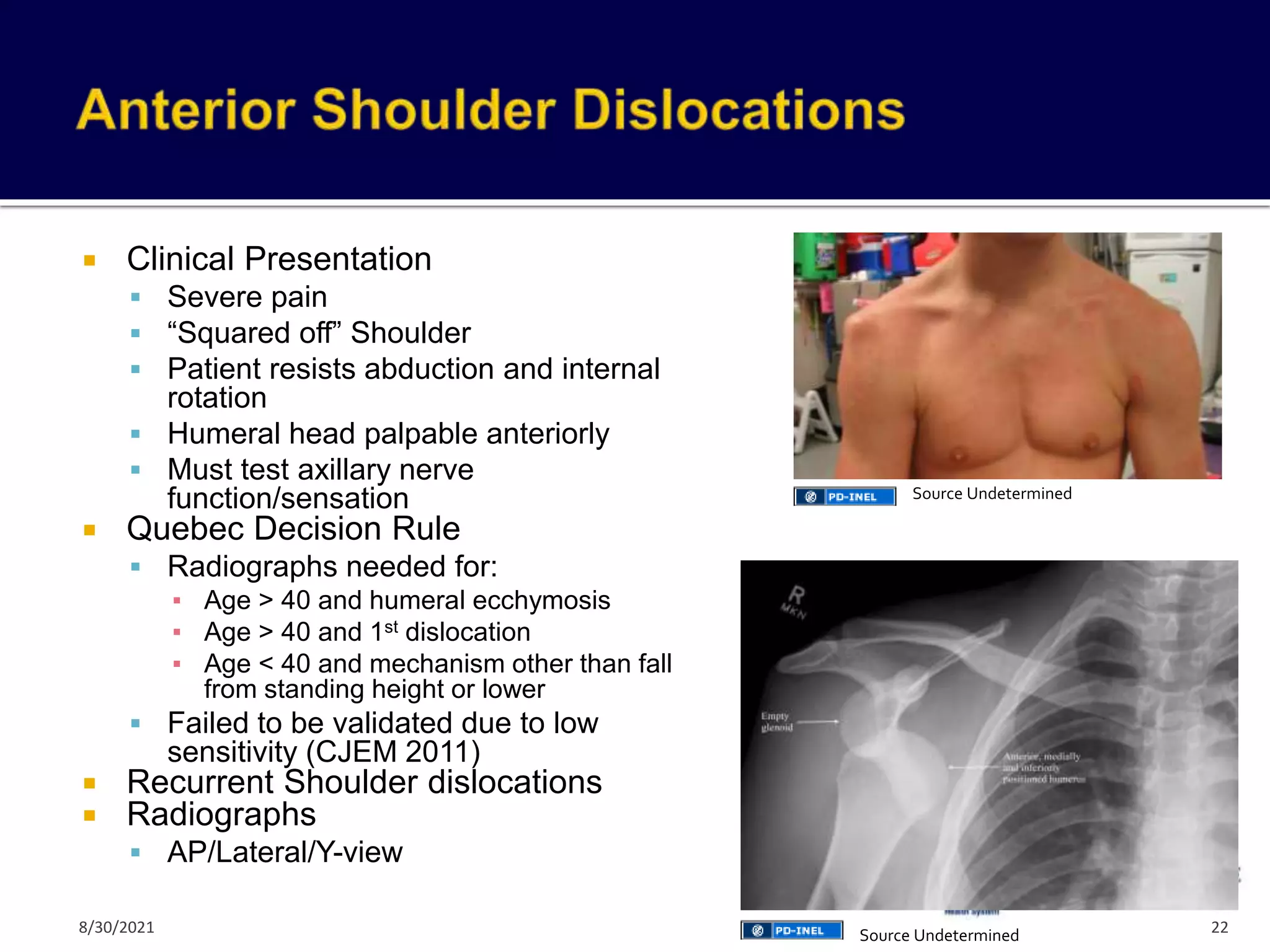  Clinical Presentation
 Severe pain
 “Squared off” Shoulder
 Patient resists abduction and internal
rotation
 Humeral head palpable anteriorly
 Must test axillary nerve
function/sensation
 Quebec Decision Rule
 Radiographs needed for:
▪ Age > 40 and humeral ecchymosis
▪ Age > 40 and 1st dislocation
▪ Age < 40 and mechanism other than fall
from standing height or lower
 Failed to be validated due to low
sensitivity (CJEM 2011)
 Recurrent Shoulder dislocations
 Radiographs
 AP/Lateral/Y-view
22
Source Undetermined
Source Undetermined
8/30/2021
 