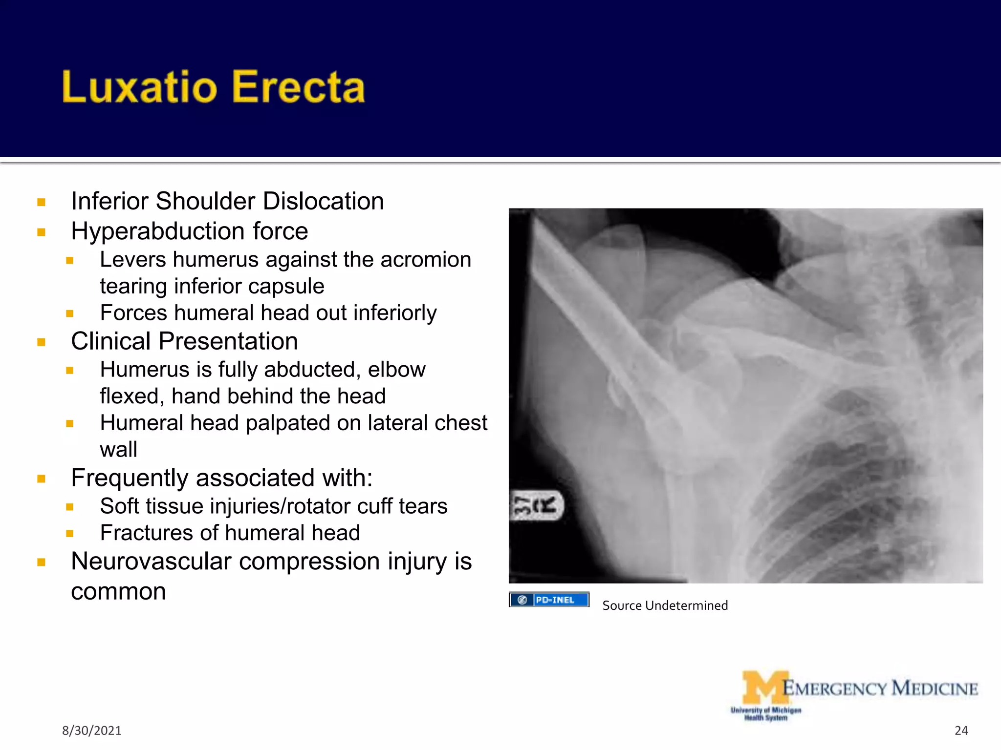 Inferior Shoulder Dislocation
 Hyperabduction force
 Levers humerus against the acromion
tearing inferior capsule
 Forces humeral head out inferiorly
 Clinical Presentation
 Humerus is fully abducted, elbow
flexed, hand behind the head
 Humeral head palpated on lateral chest
wall
 Frequently associated with:
 Soft tissue injuries/rotator cuff tears
 Fractures of humeral head
 Neurovascular compression injury is
common
24
Source Undetermined
8/30/2021
 