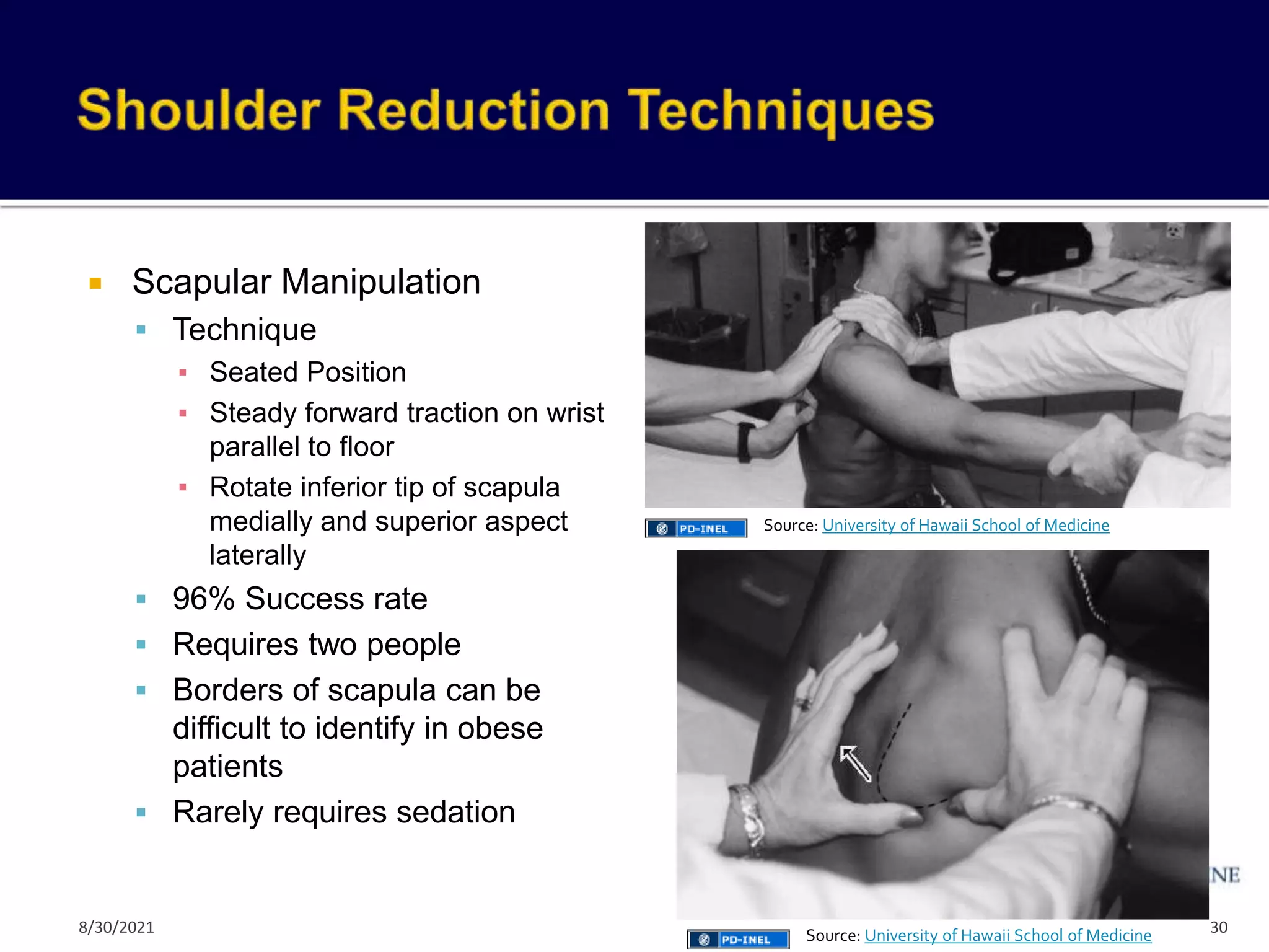  Scapular Manipulation
 Technique
▪ Seated Position
▪ Steady forward traction on wrist
parallel to floor
▪ Rotate inferior tip of scapula
medially and superior aspect
laterally
 96% Success rate
 Requires two people
 Borders of scapula can be
difficult to identify in obese
patients
 Rarely requires sedation
30
Source: University of Hawaii School of Medicine
Source: University of Hawaii School of Medicine
8/30/2021
 
