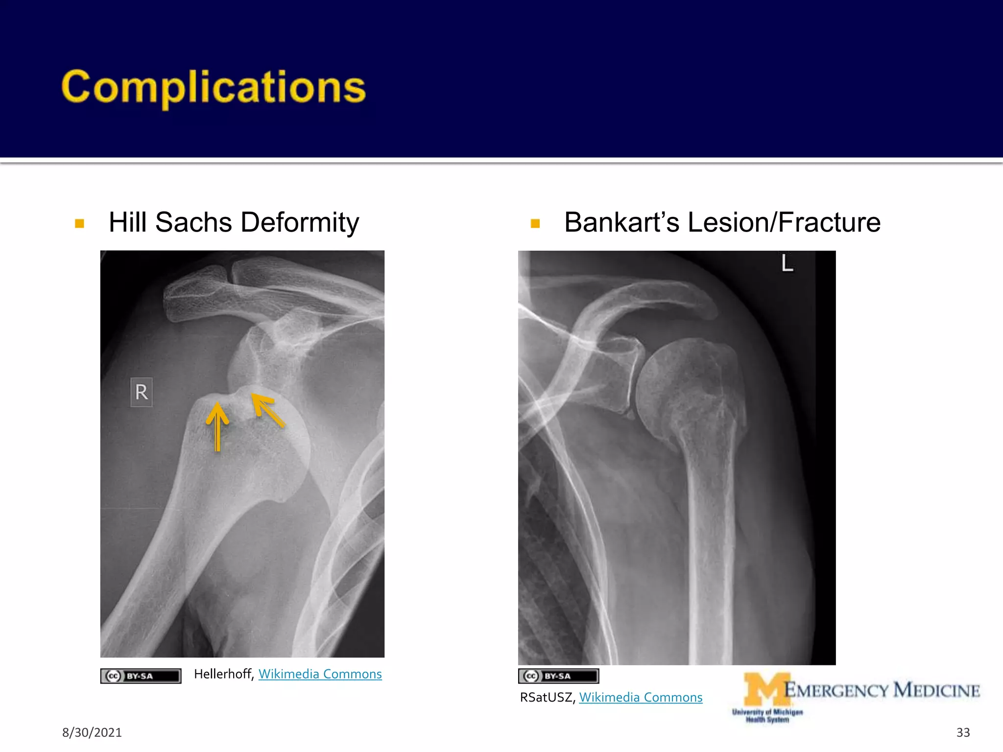 Hill Sachs Deformity  Bankart’s Lesion/Fracture
http://www.mypacs.net/repos/mpv3_repo/viz/ful
l/18712/935613.jpg
33
Hellerhoff, Wikimedia Commons
RSatUSZ, Wikimedia Commons
8/30/2021
 