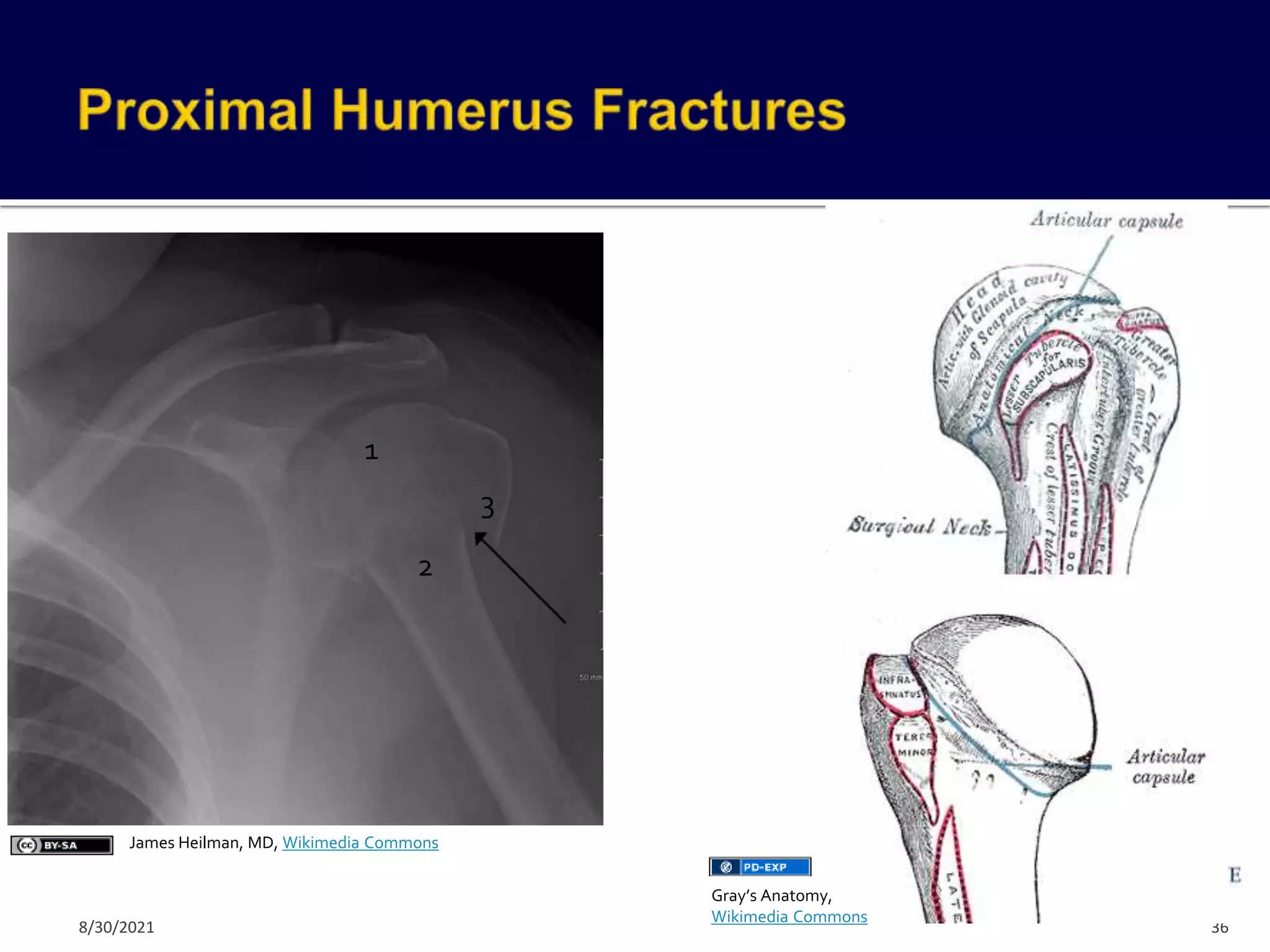 Fragments of Humerus Head
Articular surface of humeral head
Greater tubercle
Lesser tubercle
Shaft of humerus
36
3
1
2
James Heilman, MD, Wikimedia Commons
Gray’s Anatomy,
Wikimedia Commons
8/30/2021
 