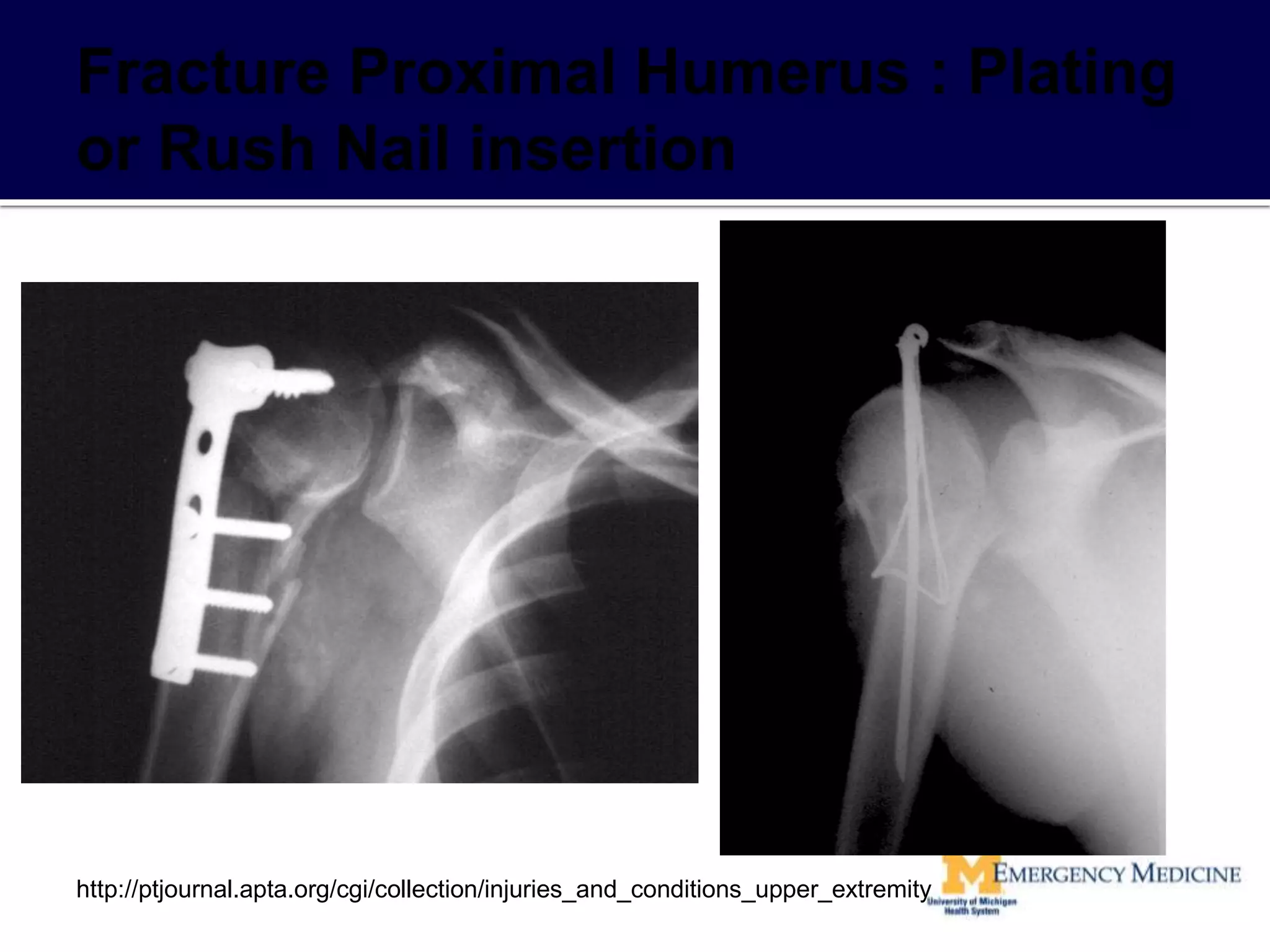 http://ptjournal.apta.org/cgi/collection/injuries_and_conditions_upper_extremity
 