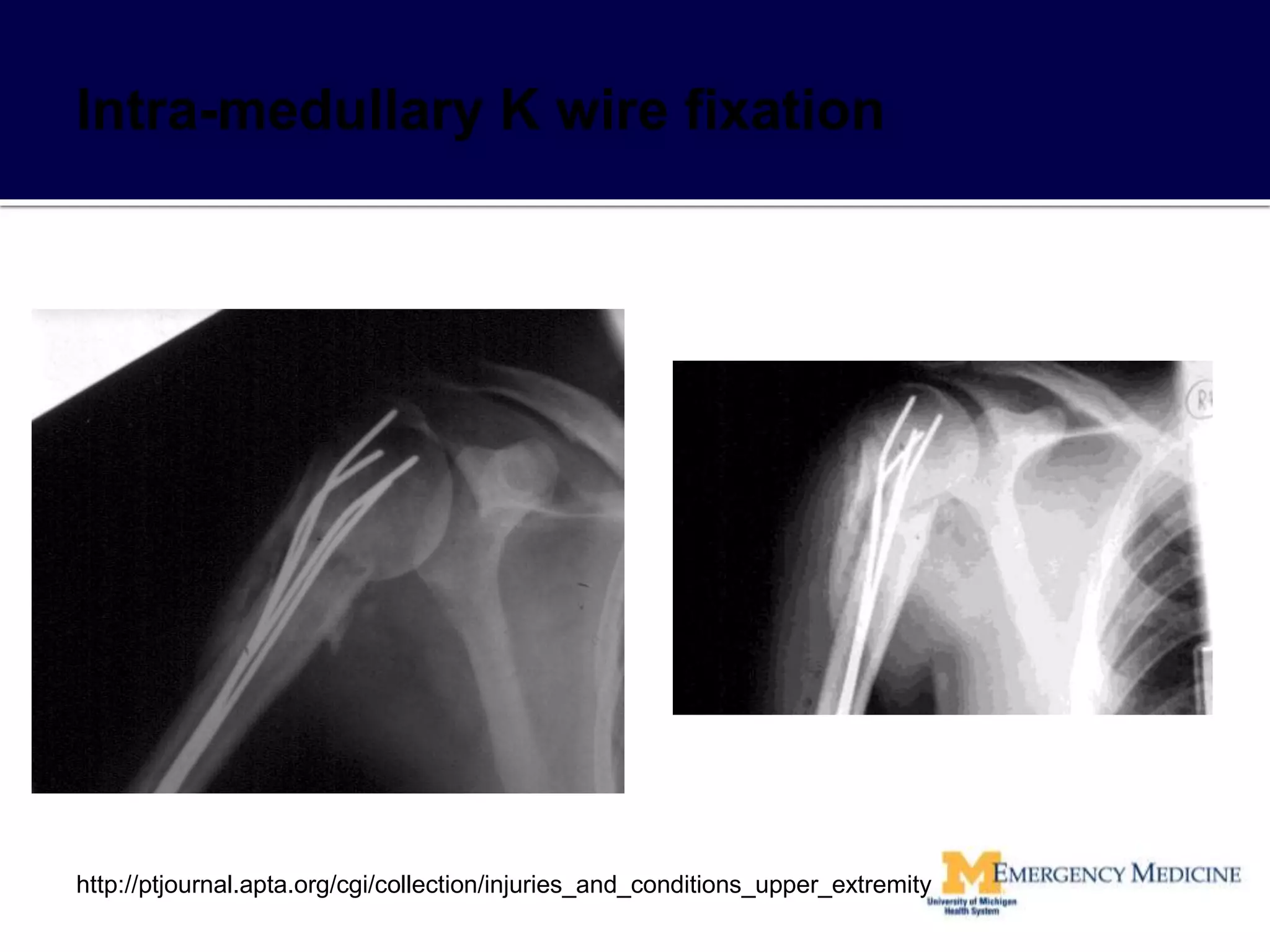 http://ptjournal.apta.org/cgi/collection/injuries_and_conditions_upper_extremity
 