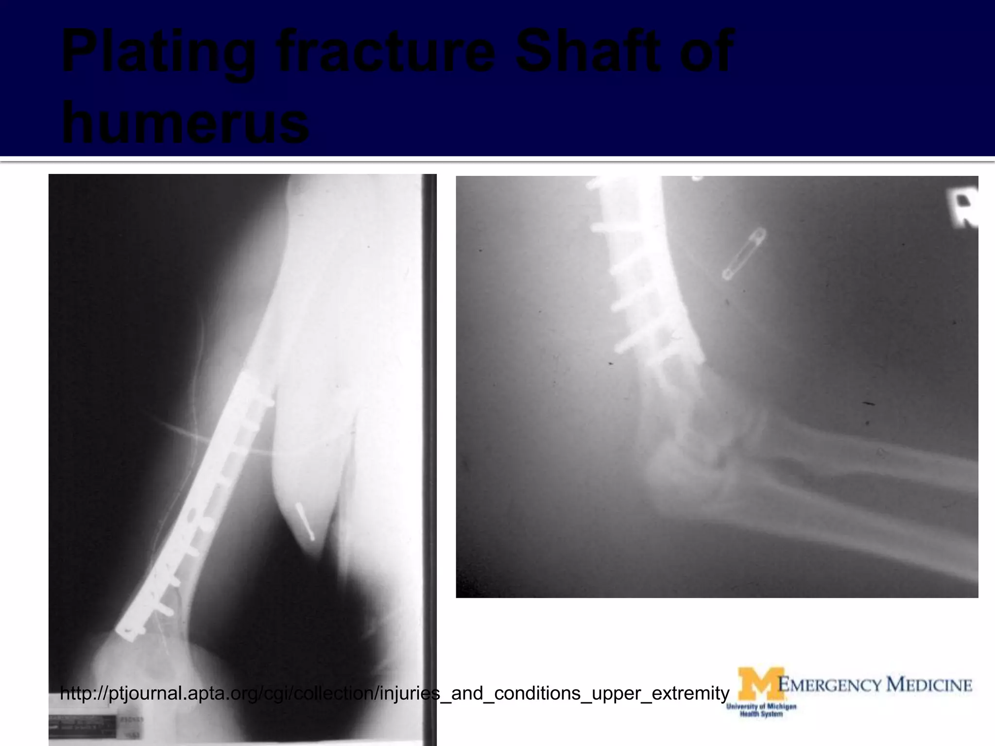 http://ptjournal.apta.org/cgi/collection/injuries_and_conditions_upper_extremity
 