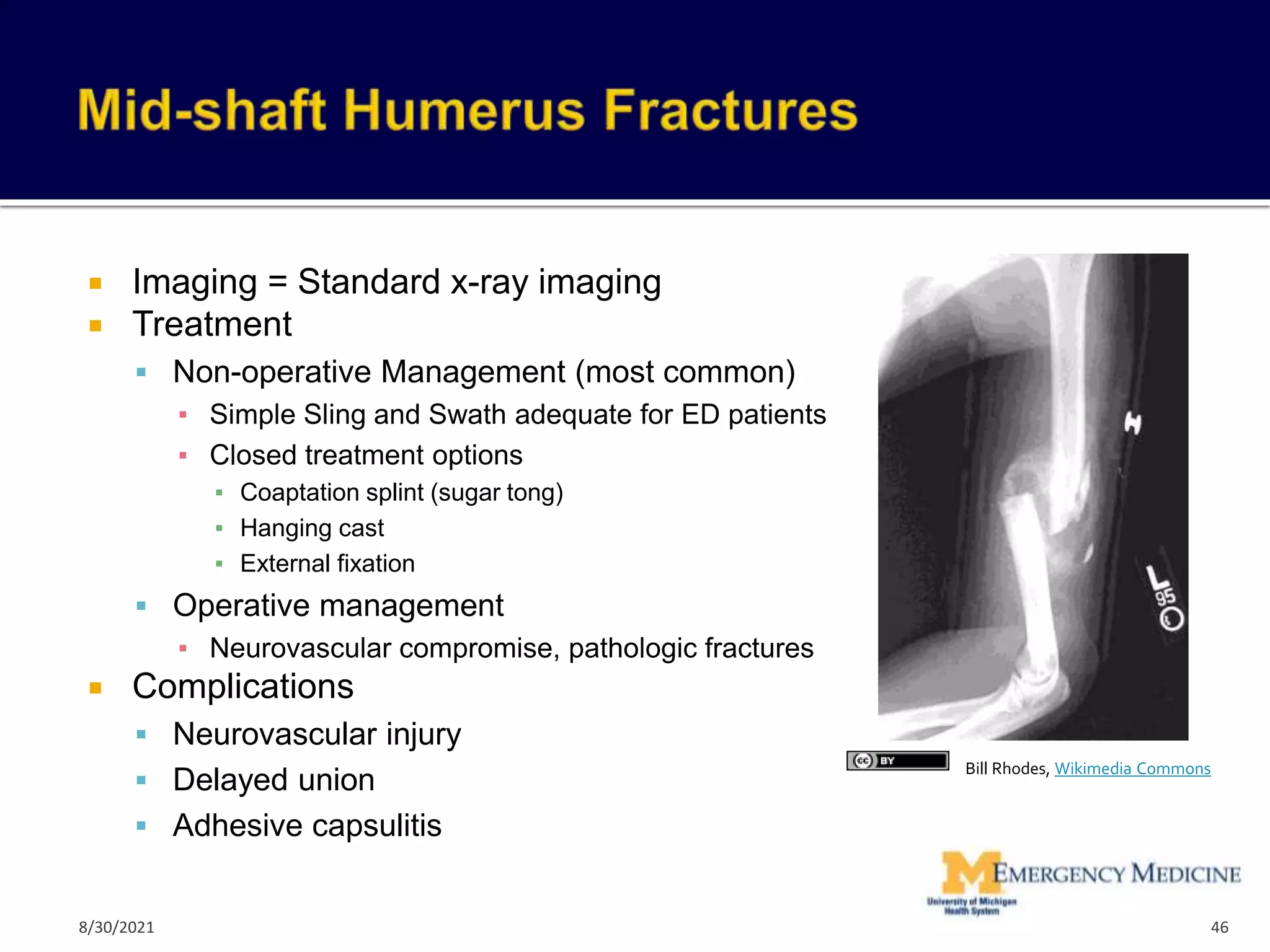  Imaging = Standard x-ray imaging
 Treatment
 Non-operative Management (most common)
▪ Simple Sling and Swath adequate for ED patients
▪ Closed treatment options
▪ Coaptation splint (sugar tong)
▪ Hanging cast
▪ External fixation
 Operative management
▪ Neurovascular compromise, pathologic fractures
 Complications
 Neurovascular injury
 Delayed union
 Adhesive capsulitis
46
Bill Rhodes, Wikimedia Commons
8/30/2021
 