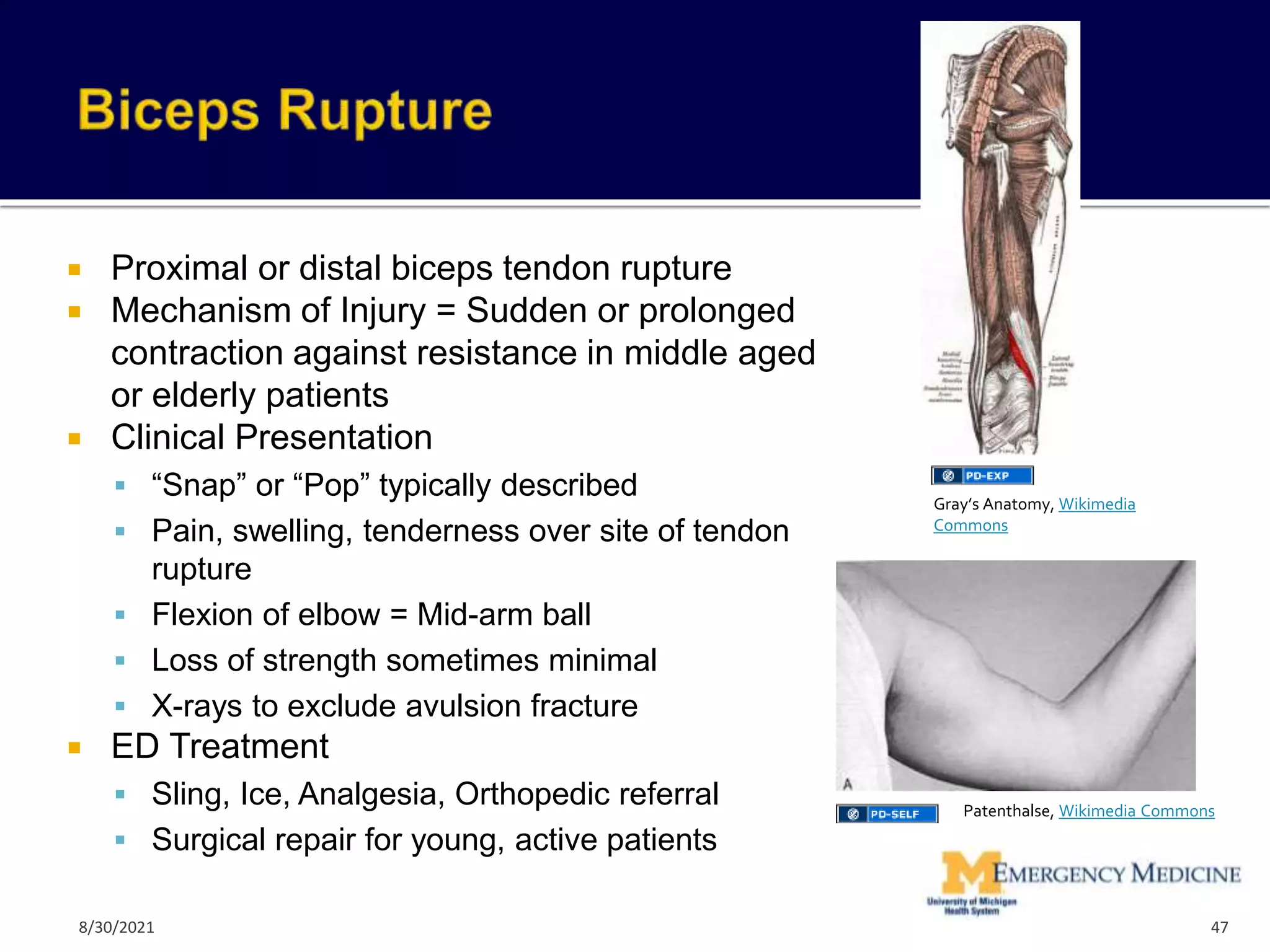  Proximal or distal biceps tendon rupture
 Mechanism of Injury = Sudden or prolonged
contraction against resistance in middle aged
or elderly patients
 Clinical Presentation
 “Snap” or “Pop” typically described
 Pain, swelling, tenderness over site of tendon
rupture
 Flexion of elbow = Mid-arm ball
 Loss of strength sometimes minimal
 X-rays to exclude avulsion fracture
 ED Treatment
 Sling, Ice, Analgesia, Orthopedic referral
 Surgical repair for young, active patients
47
Patenthalse, Wikimedia Commons
Gray’s Anatomy, Wikimedia
Commons
8/30/2021
 