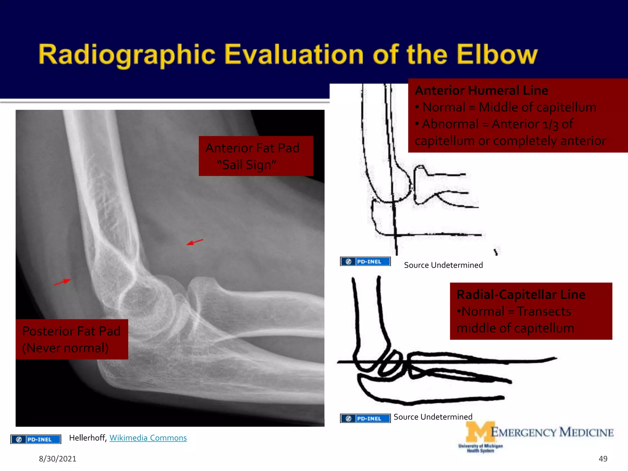 Anterior Fat Pad
“Sail Sign”
Posterior Fat Pad
(Never normal)
Anterior Humeral Line
• Normal = Middle of capitellum
• Abnormal = Anterior 1/3 of
capitellum or completely anterior
Radial-Capitellar Line
•Normal =Transects
middle of capitellum
49
Hellerhoff, Wikimedia Commons
Source Undetermined
Source Undetermined
8/30/2021
 
