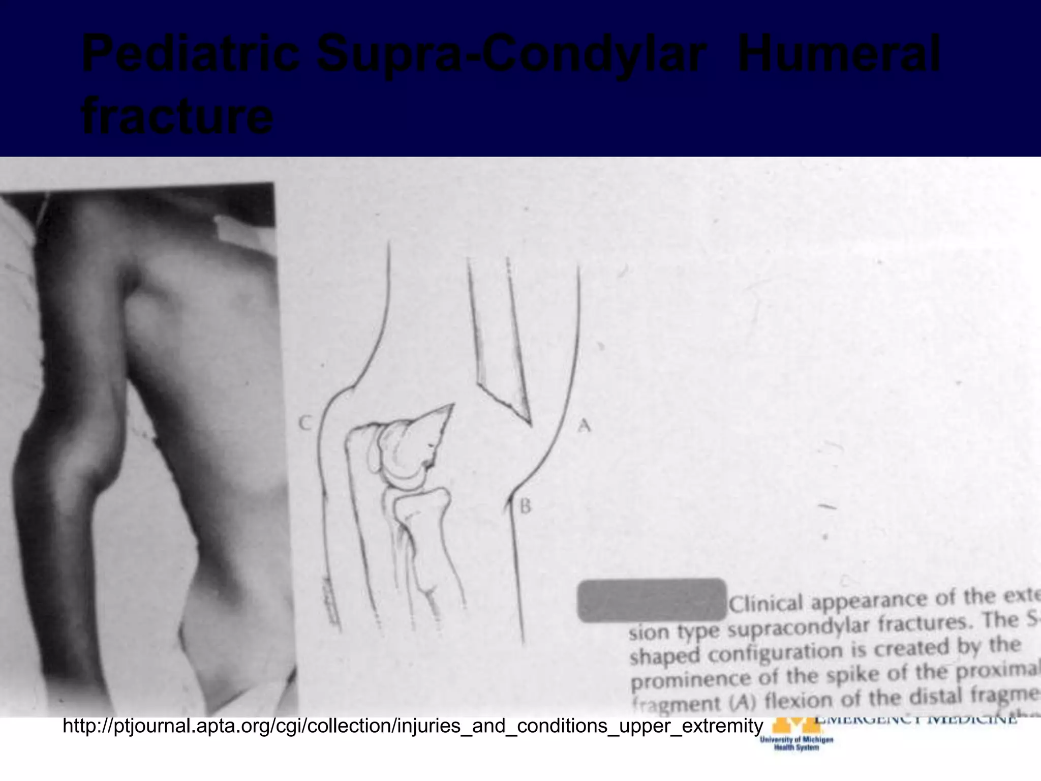 http://ptjournal.apta.org/cgi/collection/injuries_and_conditions_upper_extremity
 