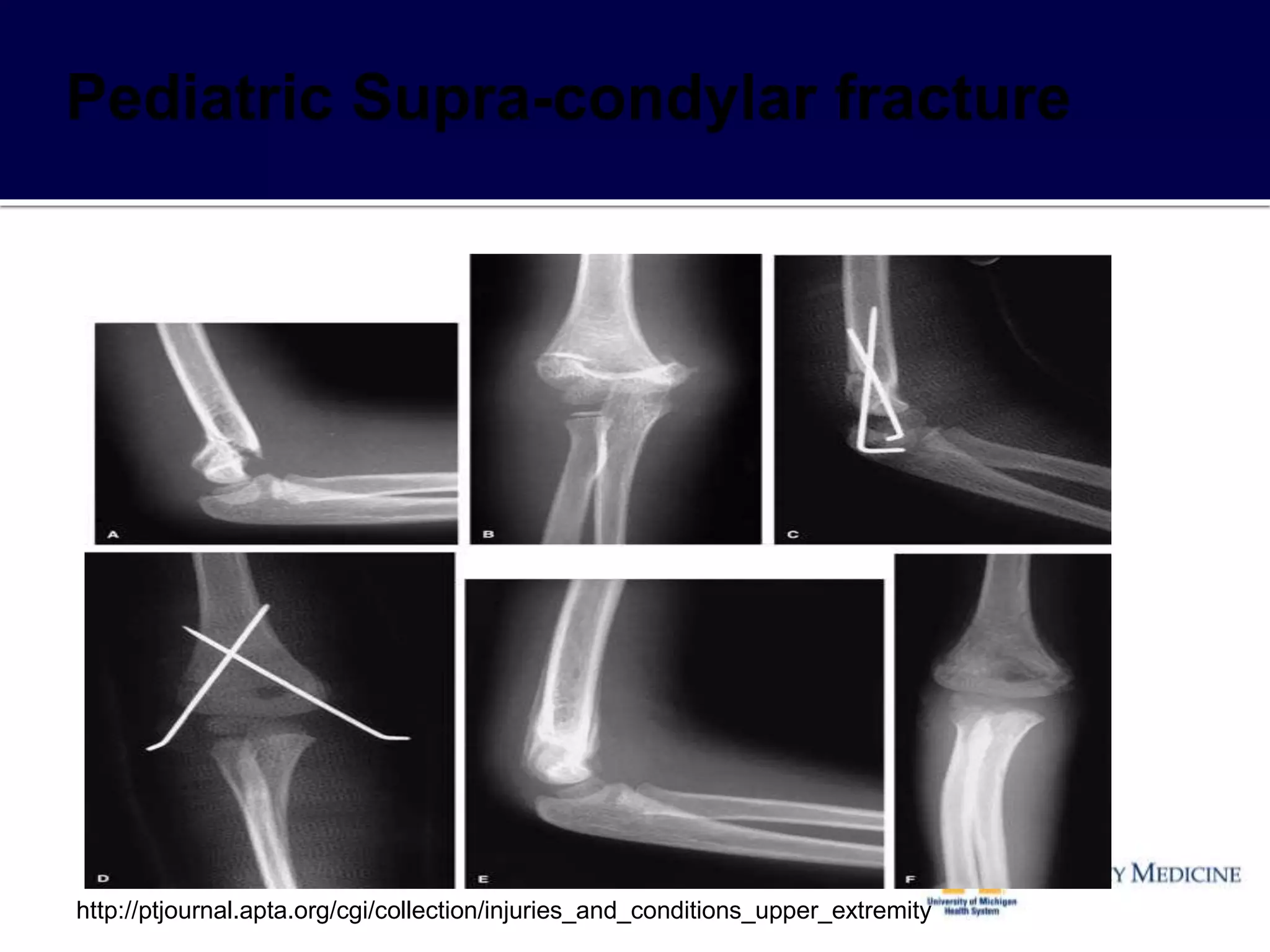 http://ptjournal.apta.org/cgi/collection/injuries_and_conditions_upper_extremity
 