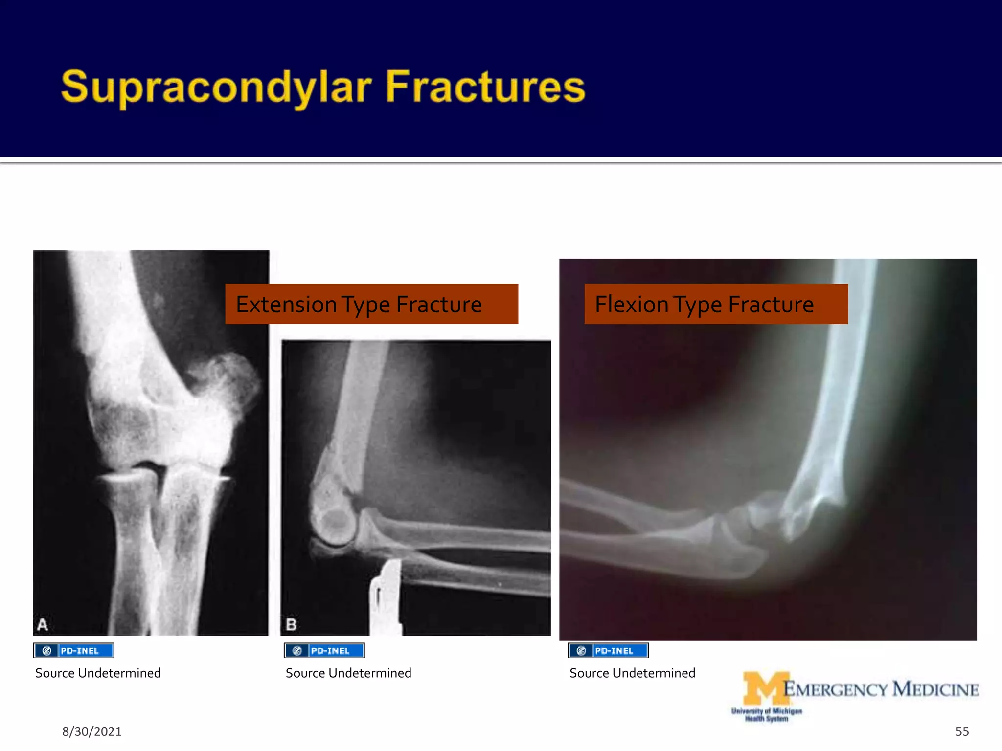 ExtensionType Fracture FlexionType Fracture
55
Source Undetermined Source Undetermined Source Undetermined
8/30/2021
 