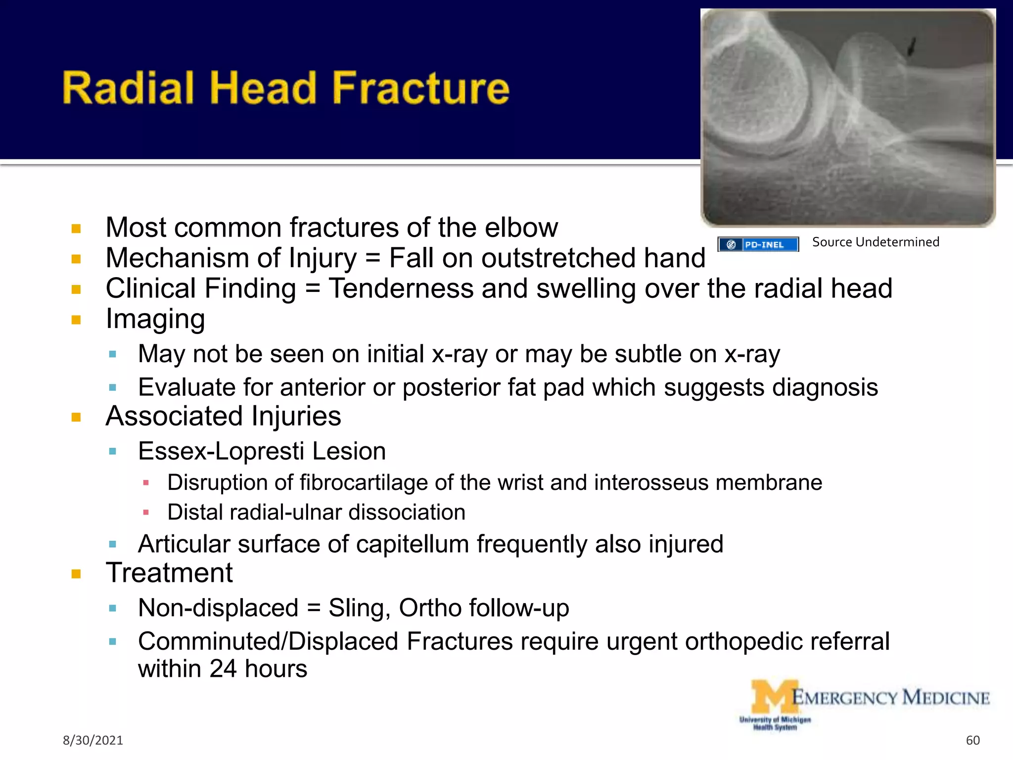  Most common fractures of the elbow
 Mechanism of Injury = Fall on outstretched hand
 Clinical Finding = Tenderness and swelling over the radial head
 Imaging
 May not be seen on initial x-ray or may be subtle on x-ray
 Evaluate for anterior or posterior fat pad which suggests diagnosis
 Associated Injuries
 Essex-Lopresti Lesion
▪ Disruption of fibrocartilage of the wrist and interosseus membrane
▪ Distal radial-ulnar dissociation
 Articular surface of capitellum frequently also injured
 Treatment
 Non-displaced = Sling, Ortho follow-up
 Comminuted/Displaced Fractures require urgent orthopedic referral
within 24 hours
60
Source Undetermined
8/30/2021
 