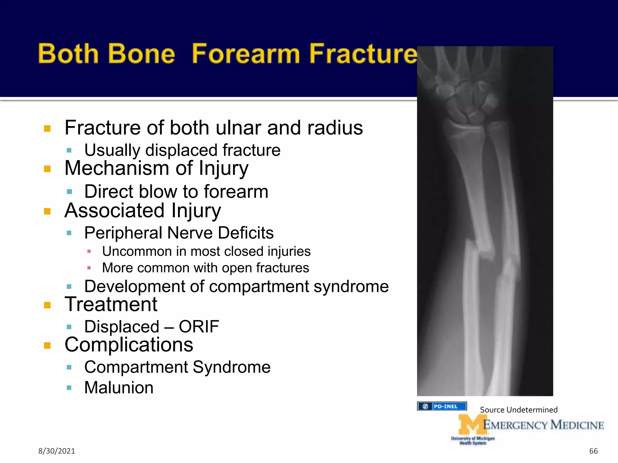  Fracture of both ulnar and radius
 Usually displaced fracture
 Mechanism of Injury
 Direct blow to forearm
 Associated Injury
 Peripheral Nerve Deficits
▪ Uncommon in most closed injuries
▪ More common with open fractures
 Development of compartment syndrome
 Treatment
 Displaced – ORIF
 Complications
 Compartment Syndrome
 Malunion
66
Source Undetermined
8/30/2021
 