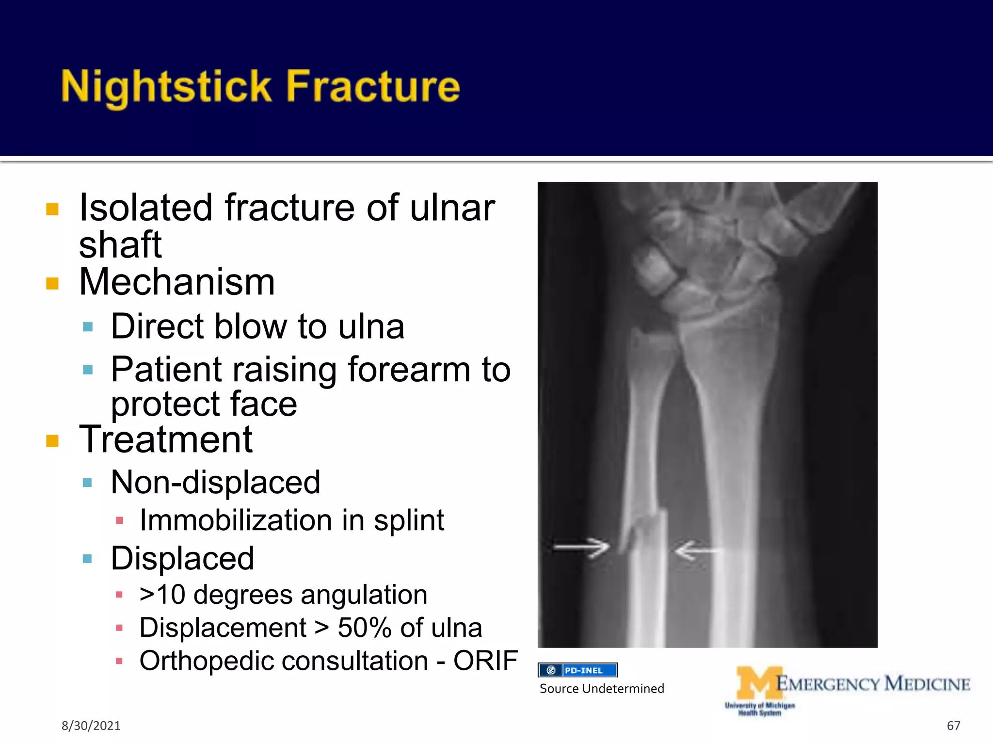  Isolated fracture of ulnar
shaft
 Mechanism
 Direct blow to ulna
 Patient raising forearm to
protect face
 Treatment
 Non-displaced
▪ Immobilization in splint
 Displaced
▪ >10 degrees angulation
▪ Displacement > 50% of ulna
▪ Orthopedic consultation - ORIF
67
Source Undetermined
8/30/2021
 