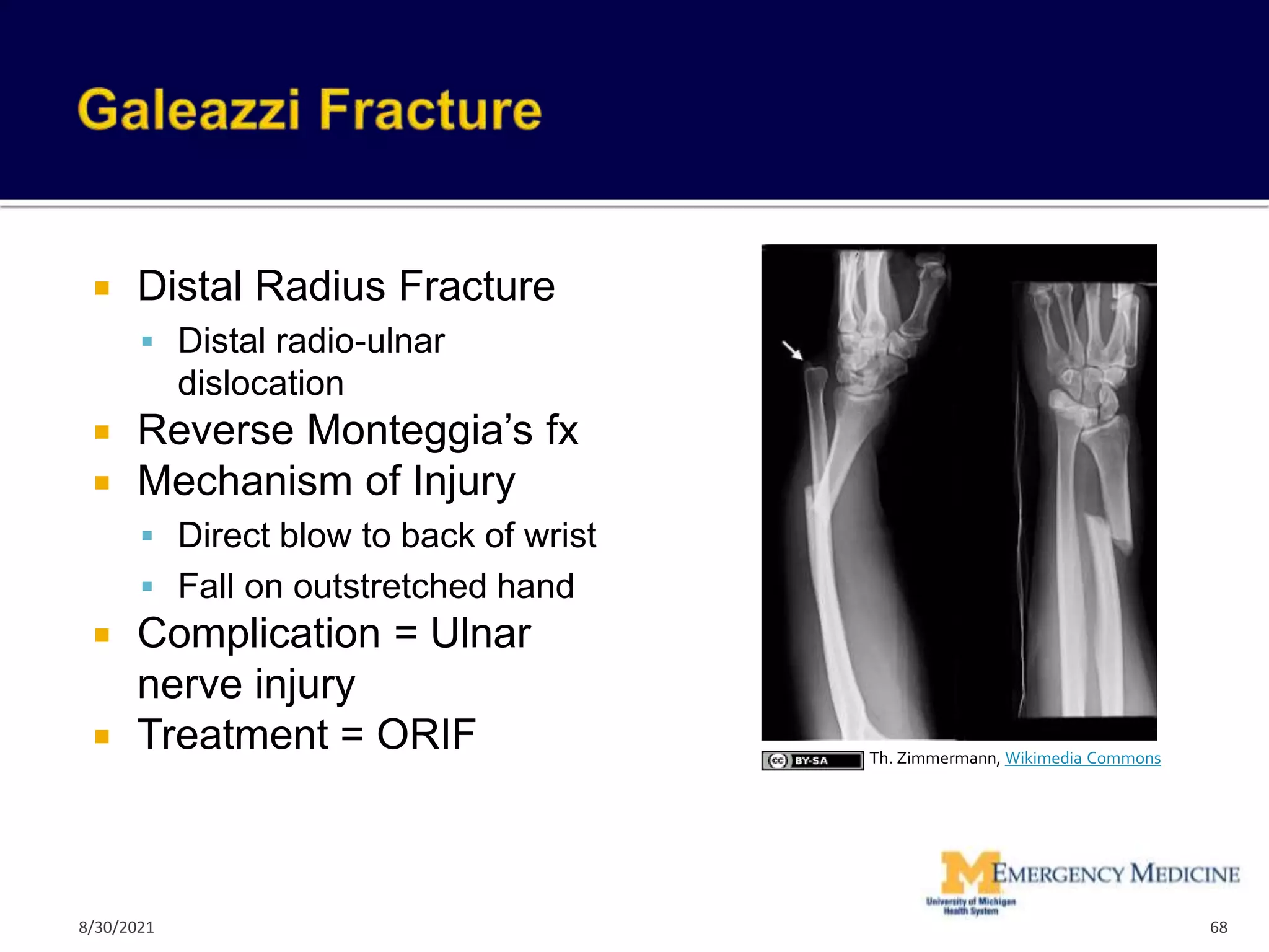  Distal Radius Fracture
 Distal radio-ulnar
dislocation
 Reverse Monteggia’s fx
 Mechanism of Injury
 Direct blow to back of wrist
 Fall on outstretched hand
 Complication = Ulnar
nerve injury
 Treatment = ORIF
http://www.learningradiology.com/caseofweek/ca
seoftheweekpix2/cow157lg.jpg
68
Th. Zimmermann, Wikimedia Commons
8/30/2021
 