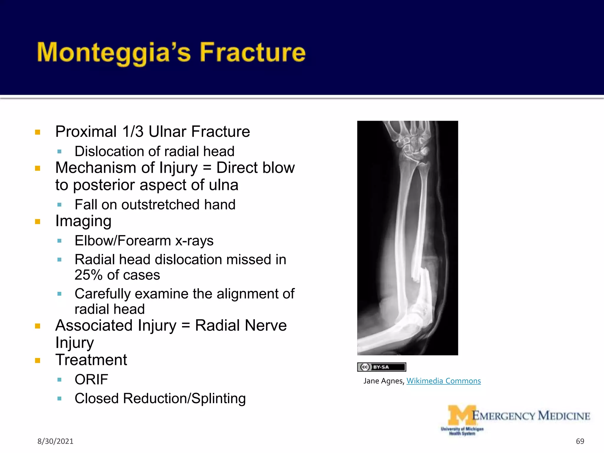  Proximal 1/3 Ulnar Fracture
 Dislocation of radial head
 Mechanism of Injury = Direct blow
to posterior aspect of ulna
 Fall on outstretched hand
 Imaging
 Elbow/Forearm x-rays
 Radial head dislocation missed in
25% of cases
 Carefully examine the alignment of
radial head
 Associated Injury = Radial Nerve
Injury
 Treatment
 ORIF
 Closed Reduction/Splinting
69
Jane Agnes, Wikimedia Commons
8/30/2021
 