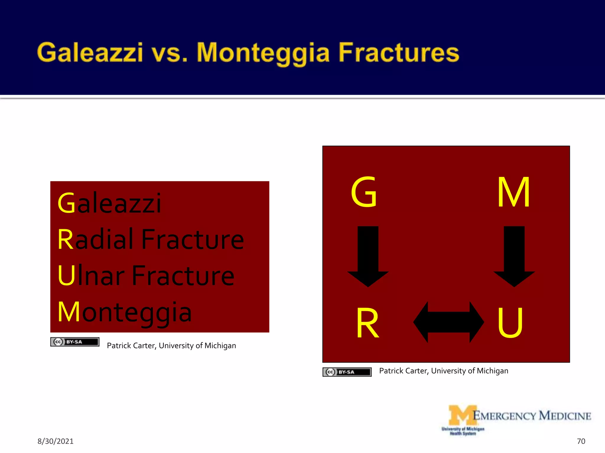 Galeazzi
Radial Fracture
Ulnar Fracture
Monteggia
G M
U
R
70
Patrick Carter, University of Michigan
Patrick Carter, University of Michigan
8/30/2021
 