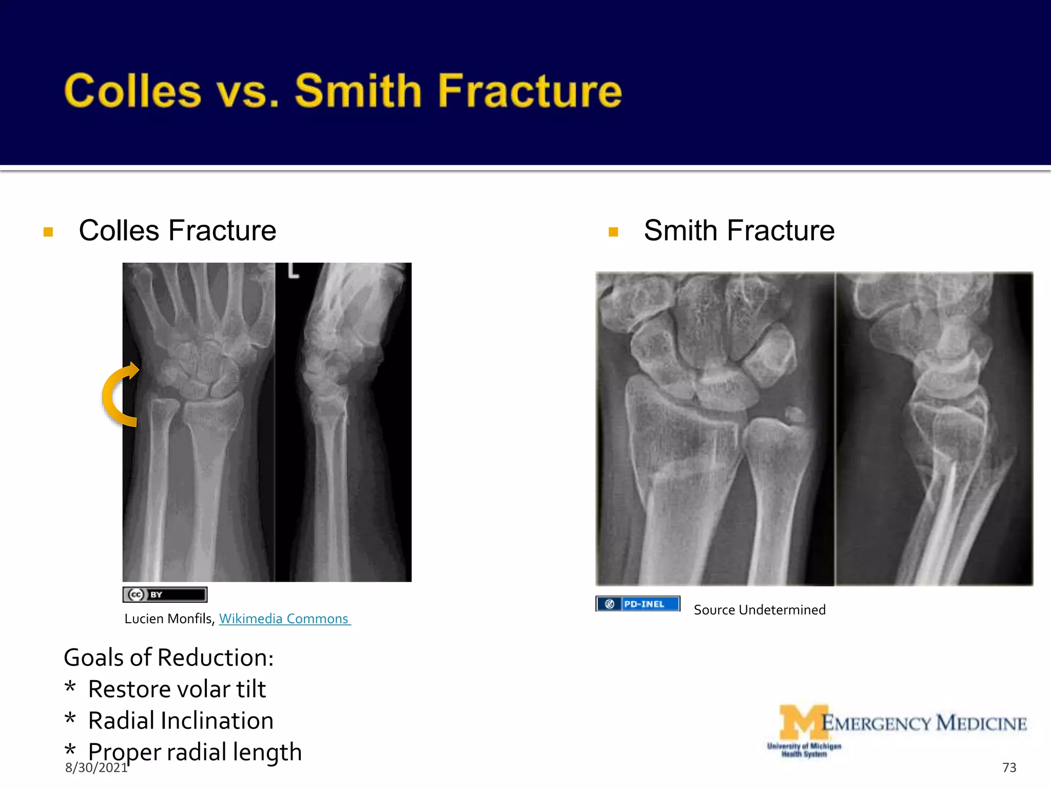  Colles Fracture  Smith Fracture
Goals of Reduction:
* Restore volar tilt
* Radial Inclination
* Proper radial length 73
Lucien Monfils, Wikimedia Commons
Source Undetermined
8/30/2021
 