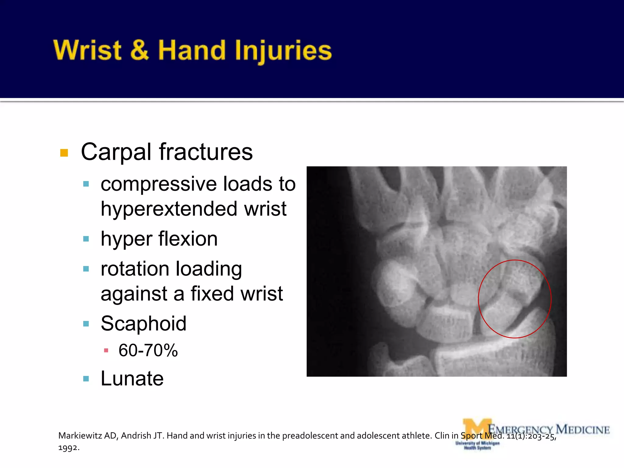  Carpal fractures
 compressive loads to
hyperextended wrist
 hyper flexion
 rotation loading
against a fixed wrist
 Scaphoid
▪ 60-70%
 Lunate
Markiewitz AD, Andrish JT. Hand and wrist injuries in the preadolescent and adolescent athlete. Clin in Sport Med. 11(1):203-25,
1992.
 