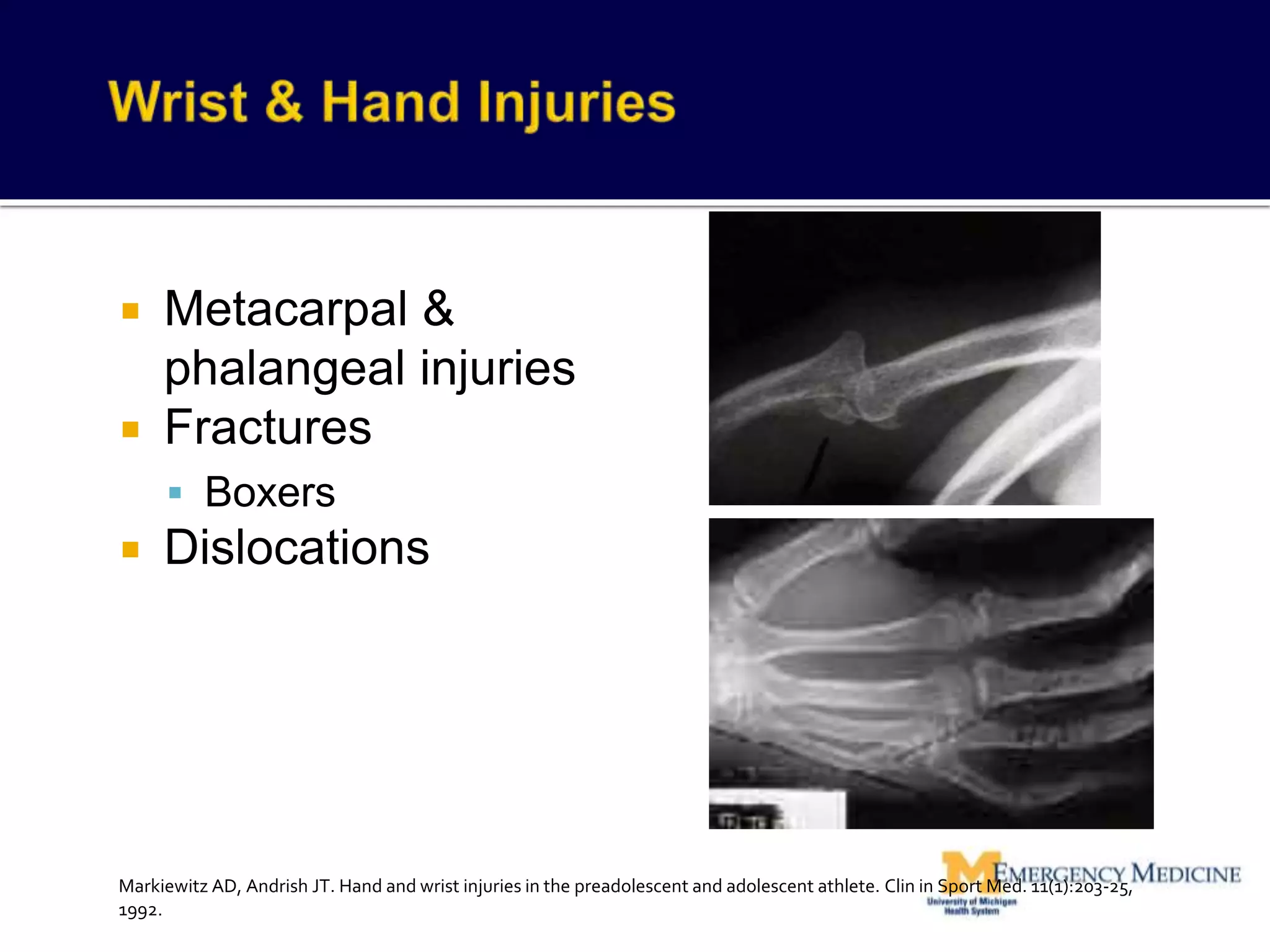  Metacarpal &
phalangeal injuries
 Fractures
 Boxers
 Dislocations
Markiewitz AD, Andrish JT. Hand and wrist injuries in the preadolescent and adolescent athlete. Clin in Sport Med. 11(1):203-25,
1992.
 