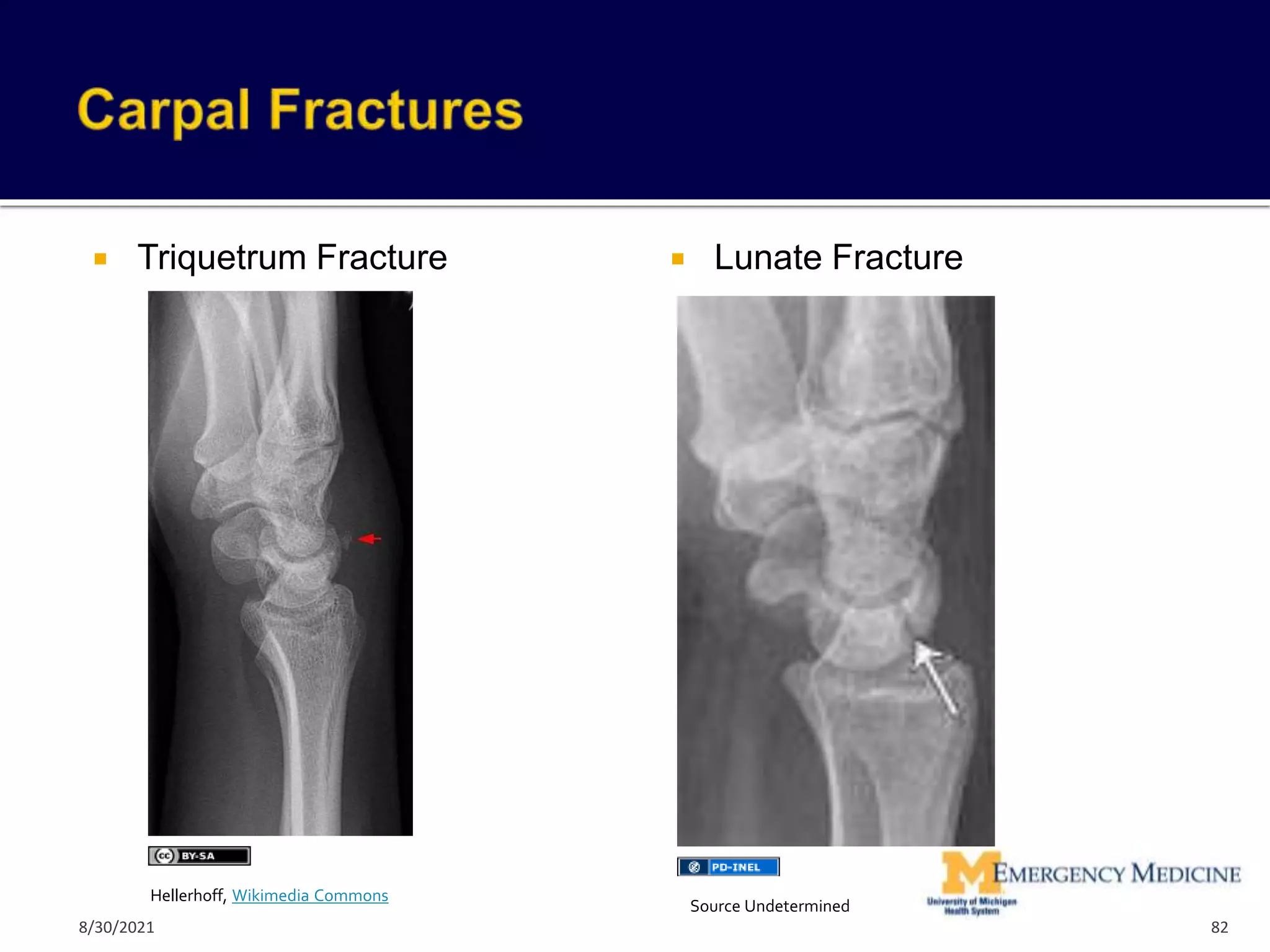  Triquetrum Fracture  Lunate Fracture
82
Hellerhoff, Wikimedia Commons
Source Undetermined
8/30/2021
 