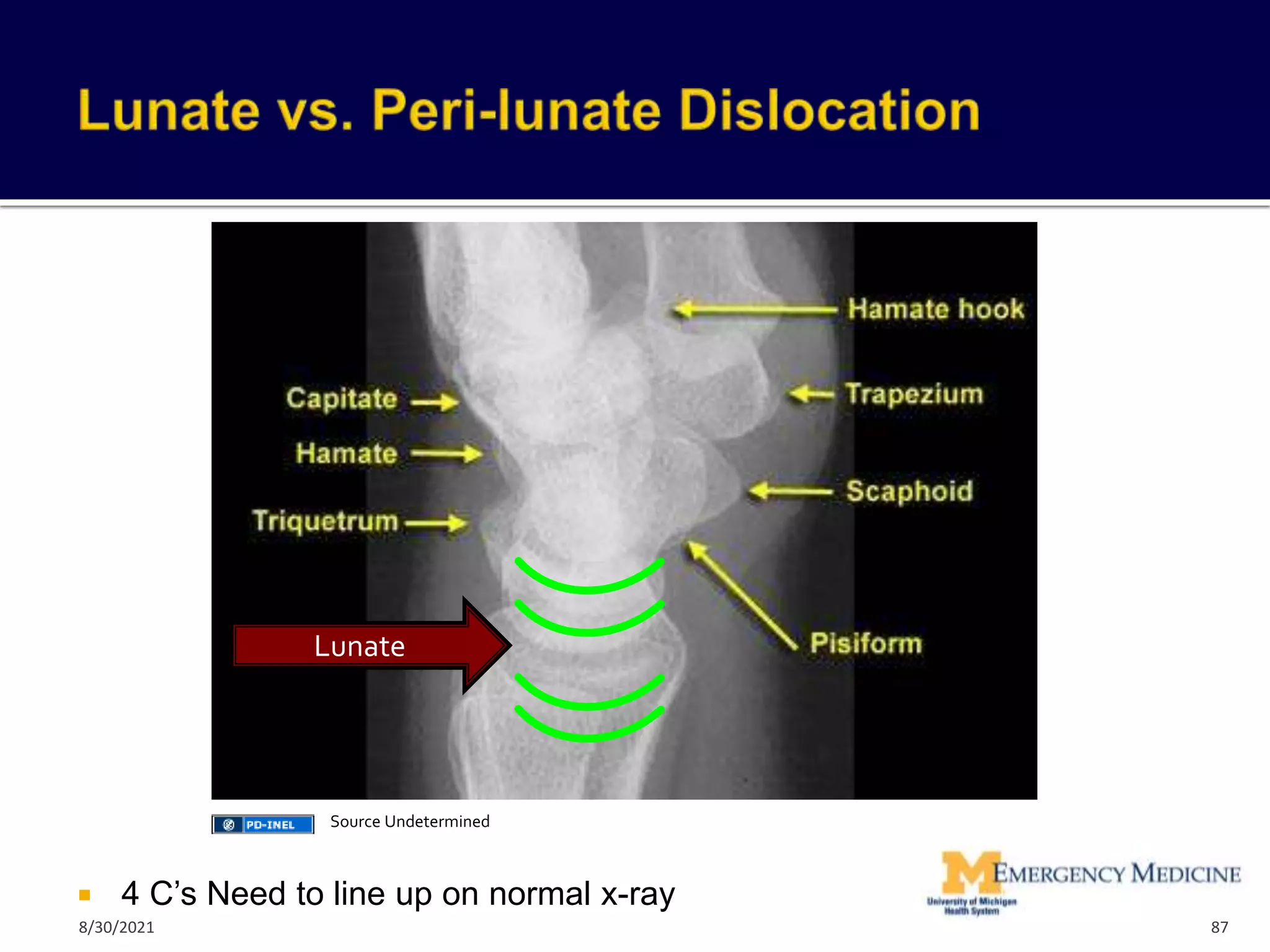  4 C’s Need to line up on normal x-ray
Lunate
87
Source Undetermined
8/30/2021
 