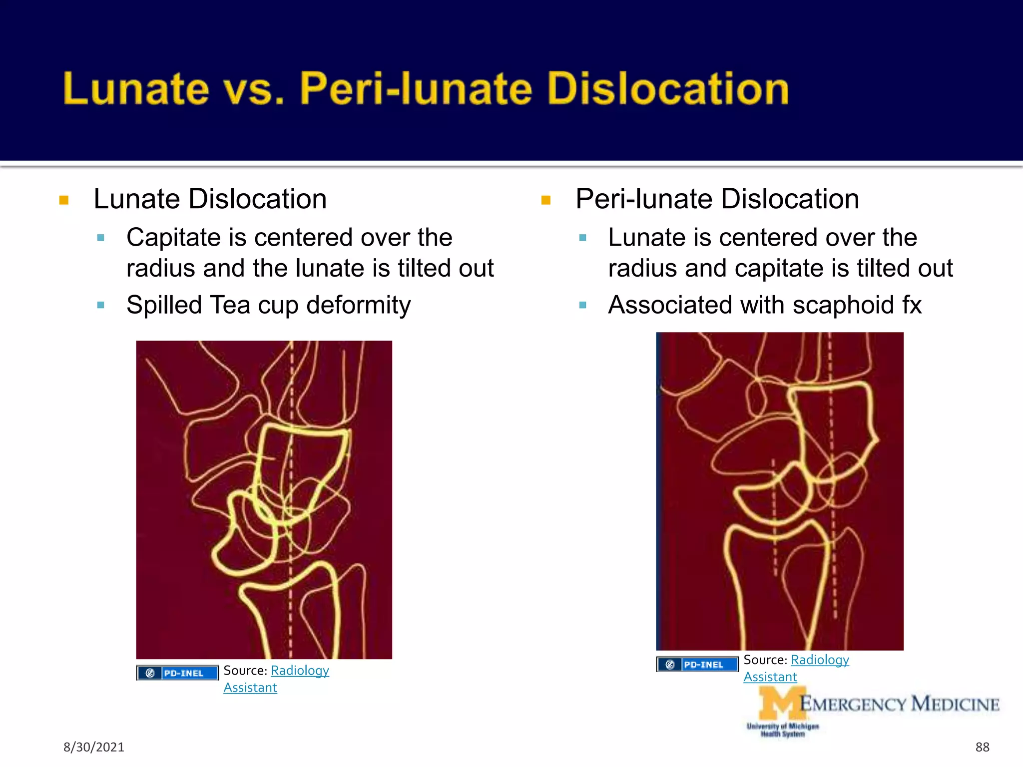  Lunate Dislocation
 Capitate is centered over the
radius and the lunate is tilted out
 Spilled Tea cup deformity
 Peri-lunate Dislocation
 Lunate is centered over the
radius and capitate is tilted out
 Associated with scaphoid fx
88
Source: Radiology
Assistant
Source: Radiology
Assistant
8/30/2021
 