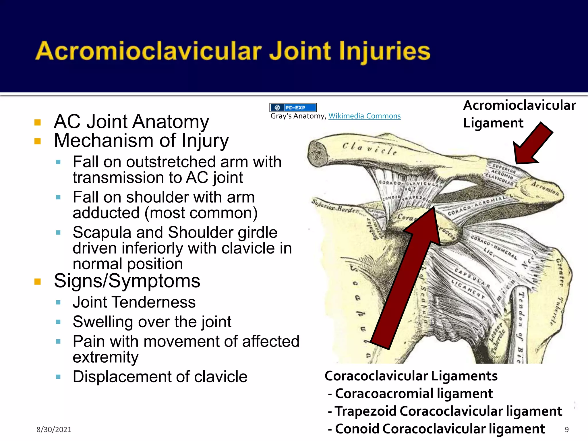  AC Joint Anatomy
 Mechanism of Injury
 Fall on outstretched arm with
transmission to AC joint
 Fall on shoulder with arm
adducted (most common)
 Scapula and Shoulder girdle
driven inferiorly with clavicle in
normal position
 Signs/Symptoms
 Joint Tenderness
 Swelling over the joint
 Pain with movement of affected
extremity
 Displacement of clavicle Coracoclavicular Ligaments
- Coracoacromial ligament
-Trapezoid Coracoclavicular ligament
- Conoid Coracoclavicular ligament
Acromioclavicular
Ligament
9
Gray’s Anatomy, Wikimedia Commons
8/30/2021
 