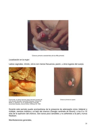 18
Chancro primario característico de la sífilis primaria
Localización en la mujer:
Labios vaginales, introito, cérvix con menos frecuencia, pezón, u otros lugares del cuerpo.
Chancroide en labios menores (signo del beso) tomado del Chancro primario en pezón
Libro de texto Sexually Transmitted Diseases. Holmes KK,
Mardh, P, Sparling P. Et, Al. Epidemiology of sexually
transmitted diseases, Second Edition. McGraw-Hill. 1990
Durante este período puede acompañarse de la presencia de adenopatía única, bilateral o
múltiple, siempre indolora y al lado del chancro (Ganglio centinela de Ricord), a los 8 a 10
días de la aparición del chancro. Son duros poco sensibles y no adheridos a la piel y nunca
fistulizan.
Manifestaciones generales.
 