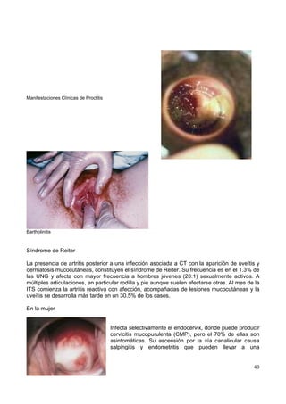 40
Manifestaciones Clínicas de Proctitis
Bartholinitis
Síndrome de Reiter
La presencia de artritis posterior a una infección asociada a CT con la aparición de uveítis y
dermatosis mucocutáneas, constituyen el síndrome de Reiter. Su frecuencia es en el 1.3% de
las UNG y afecta con mayor frecuencia a hombres jóvenes (20:1) sexualmente activos. A
múltiples articulaciones, en particular rodilla y pie aunque suelen afectarse otras. Al mes de la
ITS comienza la artritis reactiva con afección, acompañadas de lesiones mucocutáneas y la
uveítis se desarrolla más tarde en un 30.5% de los casos.
En la mujer
Infecta selectivamente el endocérvix, donde puede producir
cervicitis mucopurulenta (CMP), pero el 70% de ellas son
asintomáticas. Su ascensión por la vía canalicular causa
salpingitis y endometritis que pueden llevar a una
 