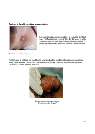 60
Capitulo X. Condilomas (Verrugas genitales)
Los condilomas acuminados (CA) o verrugas genitales
son neoformaciones vegetantes de tamaño y color
variables, que se asientan en la región ano genital. En
general los pacientes no presentan síntomas subjetivos.
Condilomas anales en mujer joven
A lo largo de la historia, los condilomas acuminados han tenido múltiples denominaciones:
higos (para griegos y romanos), vegetaciones venéreas, verrugas gonocócicas, verrugas
venéreas, “crestas de gallo” (México)
Condilomas acuminados en glande y
Prepucio “crestas de gallo”
 