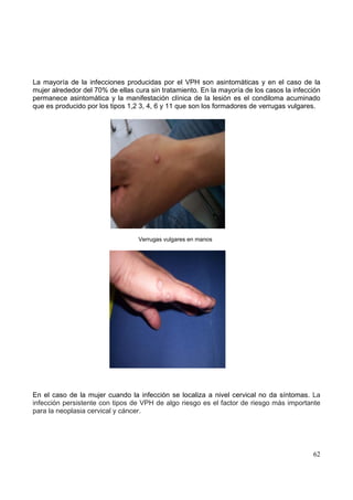 62
La mayoría de la infecciones producidas por el VPH son asintomáticas y en el caso de la
mujer alrededor del 70% de ellas cura sin tratamiento. En la mayoría de los casos la infección
permanece asintomática y la manifestación clínica de la lesión es el condiloma acuminado
que es producido por los tipos 1,2 3, 4, 6 y 11 que son los formadores de verrugas vulgares.
Verrugas vulgares en manos
En el caso de la mujer cuando la infección se localiza a nivel cervical no da síntomas. La
infección persistente con tipos de VPH de algo riesgo es el factor de riesgo más importante
para la neoplasia cervical y cáncer.
 