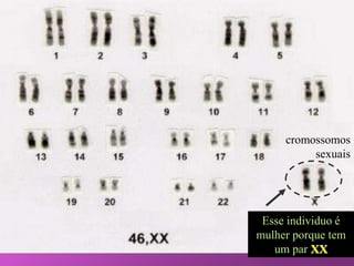 O óvulo e o
espermatozóide
O Homem produz
espermatozóides com 22
cromossomos + um
cromossomo X ou Y, pois
ele tem um par XY.
A mulher produz óvulos
com 22 cromossomos +
um cromossomo X, pois
ela tem um par XX
Quando ocorre a
fecundação, teremos 22
cromossomos do homem
+ 22 da mulher que será
igual a 46 cromossomos,
sendo um par sexual que
pode ser XX (mulher) ou
XY (homem), depende
de que espermatozóide
penetrou no óvulo!
Verifique como são os nossos
cromossomos, observe que temos 22
+ um par de cromossomo sexual,
dando um total de 46 cromossomos
para os seres humanos.
Esse individuo é
mulher porque tem
um par XX
cromossomos
sexuais
 