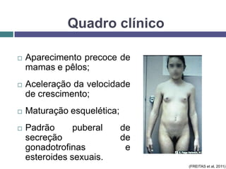 Quadro clínico


Aparecimento precoce de
mamas e pêlos;



Aceleração da velocidade
de crescimento;



Maturação esquelética;



Padrão
puberal
secreção
gonadotrofinas
esteroides sexuais.

de
de
e
(FREITAS et al, 2011)

 