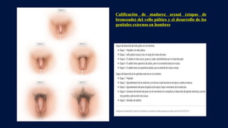 Calificación de madurez sexual (etapas de
bronceado) del vello púbico y el desarrollo de los
genitales externos en hombres
 