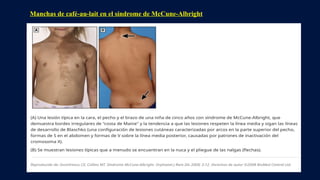 Manchas de café-au-lait en el síndrome de McCune-Albright
 