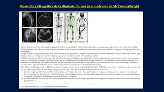 Aparición radiográfica de la displasia fibrosa en el síndrome de McCune-Albright
 