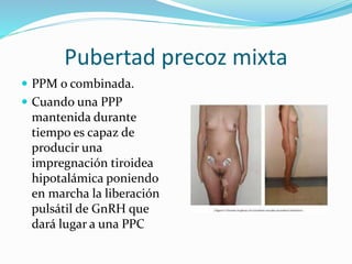 Pubertad precoz mixta 
 PPM o combinada. 
 Cuando una PPP 
mantenida durante 
tiempo es capaz de 
producir una 
impregnación tiroidea 
hipotalámica poniendo 
en marcha la liberación 
pulsátil de GnRH que 
dará lugar a una PPC 
 