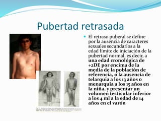 Pubertad retrasada 
 El retraso puberal se define 
por la ausencia de caracteres 
sexuales secundarios a la 
edad límite de iniciación de la 
pubertad normal, es decir, a 
una edad cronológica de 
+2DE por encima de la 
media de la población de 
referencia, o la ausencia de 
telarquia a los 13 años o 
menarquia a los 15 años en 
la niña, y presentar un 
volumen testicular inferior 
a los 4 ml a la edad de 14 
años en el varón 
 