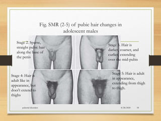 Fig. SMR (2-5) of pubic hair changes in
adolescent males
8/28/2020pubertal disorders 18
Stage 2. Sparse,
straight pubic hair
along the base of
the penis
Stage 3. Hair is
darker, coarser, and
curlier, extending
over the mid-pubis
Stage 4: Hair is
adult like in
appearance, but
does't extend to
thighs
Stage 5: Hair is adult
in appearance,
extending from thigh
to thigh.
 