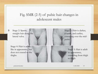 Fig. SMR (2-5) of pubic hair changes in
adolescent males
8/28/2020pubertal disorders 19
B Stage 2: Sparse,
straight hair along the
lateral vulva.
Stage 3: Hair is darker,
coarser, and curlier,
extending over the mid-
pubis.
Stage 4: Hair is adult-
like in appearance, but
does not extend to the
thighs.
Stage 5: Hair is adult
in appearance,
extending from thigh
to thigh.
 