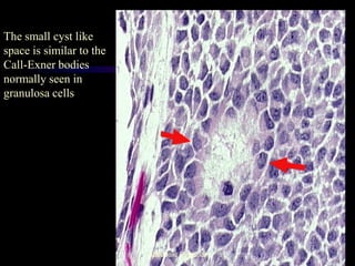 The small cyst like space is similar to the Call-Exner bodies normally seen in granulosa cells 
Aboubakr Elnashar  