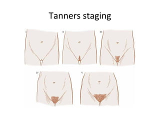 Tanners staging 
 