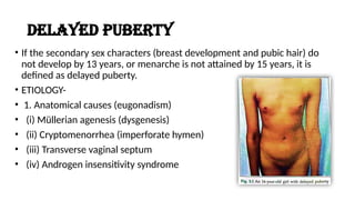 Puberty Issues PUBERTY DISORDERs ppt by doc maney .pptx