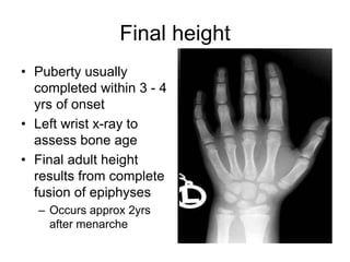 Final height
• Puberty usually
completed within 3 - 4
yrs of onset
• Left wrist x-ray to
assess bone age
• Final adult height
results from complete
fusion of epiphyses
– Occurs approx 2yrs
after menarche
 