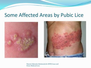 Some Affected Areas by Pubic Lice
Ibiyemi Ademola Adedamola for MFM Grace and
Power Medical Crew
 