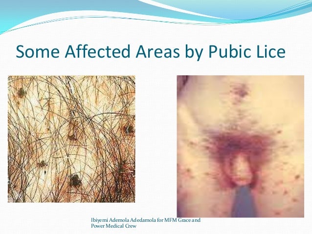 Pubic Lice