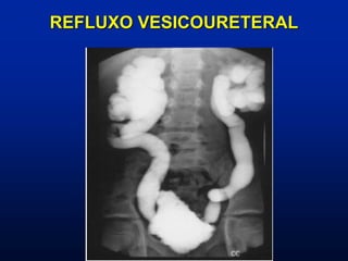 REFLUXO VESICOURETERAL
 