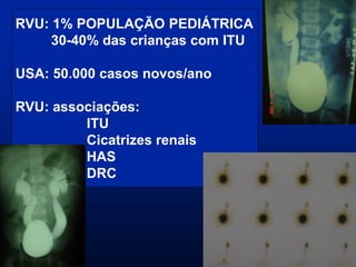 RVU: 1% POPULAÇÃO PEDIÁTRICA
30-40% das crianças com ITU
USA: 50.000 casos novos/ano
RVU: associações:
ITU
Cicatrizes renais
HAS
DRC
 